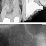 Tooth X-Ray